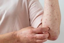 هشدار یک متخصص درباره شیوع بیماری عفونی در فصل بهار/ این نشانه‌ها را جدی بگیرید