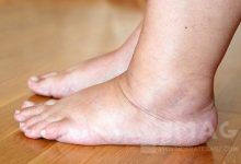 ورم ناگهانی پا چرا خطرناک است؟