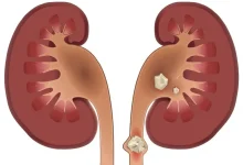 سنگ کلیه چه علائمی دارد؟