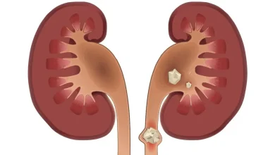سنگ کلیه چه علائمی دارد؟