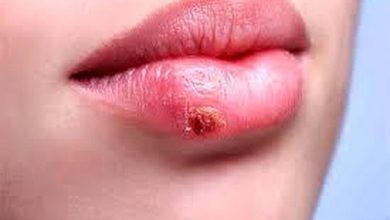 چرا تبخال با استرس تشدید می‌شود؟ / این چند راهکار ساده را انجام دهید