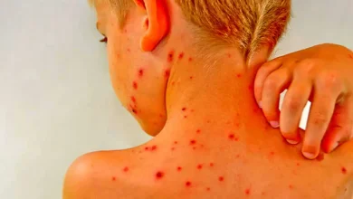 آنچه والدین باید درباره آبله‌مرغان و زونا بدانند